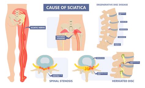 Lower Back, Hip, and SI Joint Pain - ResilientRx