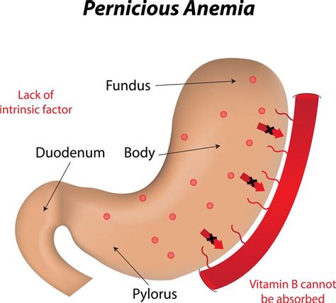 Vitamin B12 deficiency Guide: Causes, Symptoms and Treatment Options