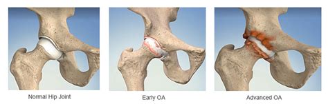 Arthritis | Types of Arthritis | Arthritic Pain