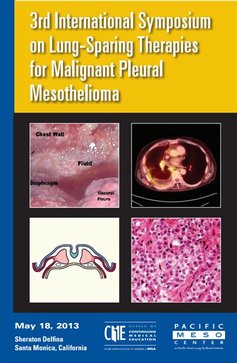 Malignant Mesothelioma Of Lung - Mesothelioma - Symptoms, Causes, Types ...