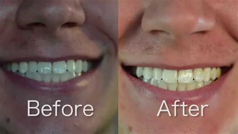 Crest 3D White Whitestrips 1 Hr Express Review and Before/After - YouTube