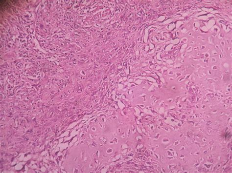 CHONDROSARCOMA – Histopathology.guru