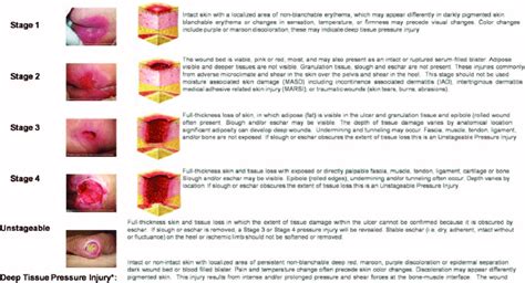 National Pressure Ulcer Advisory Panel pressure ulcer stages. A staging ...