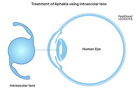 Aphakia – the absence of the crystalline lens of the eye | Feel Good ...