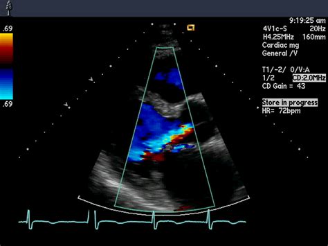 Color Doppler – Cardiovascular Education