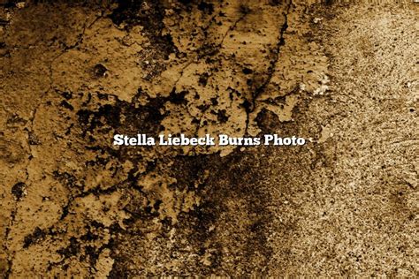 Stella Liebeck Burns Photo - November 2024 - Tomaswhitehouse.com