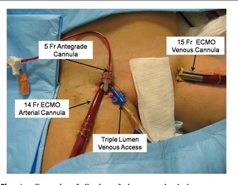 Femoral Quinton Catheter