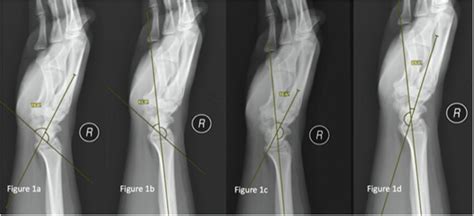 a Lateral scapholunate angle, b lateral radio-scaphoid angle, c lateral ...