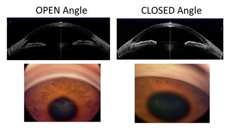 Angle Closure Glaucoma | What is it, Causes and Treatment