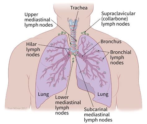 NSCLC Staging | American Cancer Society