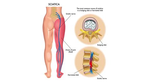 5 Sciatica Symptoms To Look For | What Are The Symptoms of Sciatica