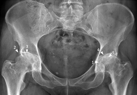 Hip osteoarthritis xray vs normal hip - geeksisse