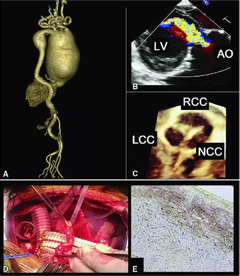 A, Preoperative computed tomographic 3D reconstruction showing dilation ...