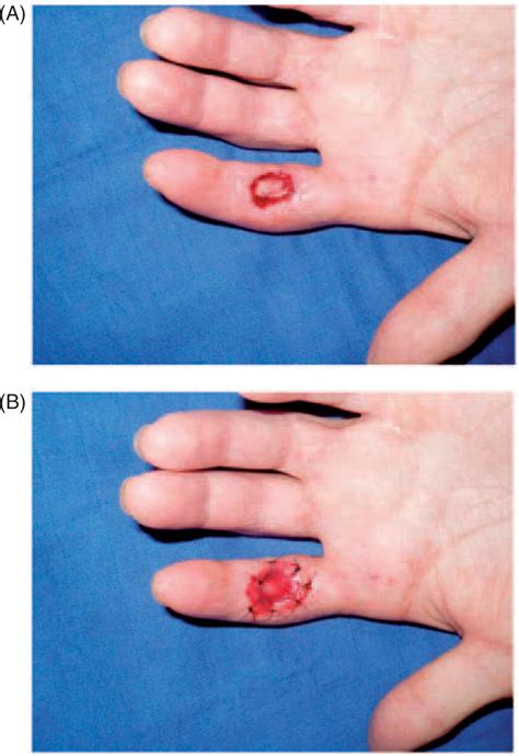 Avulsion Wound Definition