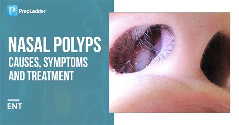 Nasal Polyps: Causes Types Symptoms Treatment – Bibo | lupon.gov.ph