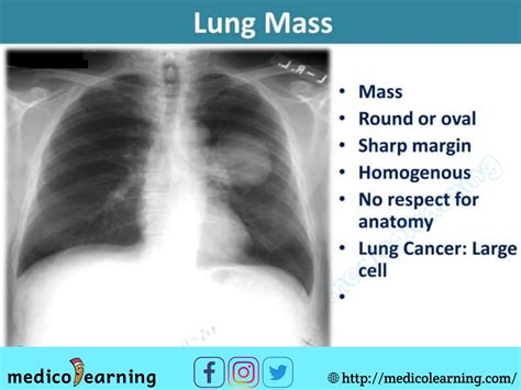 Lung mass | Medical radiography, Medical pictures, Radiology imaging