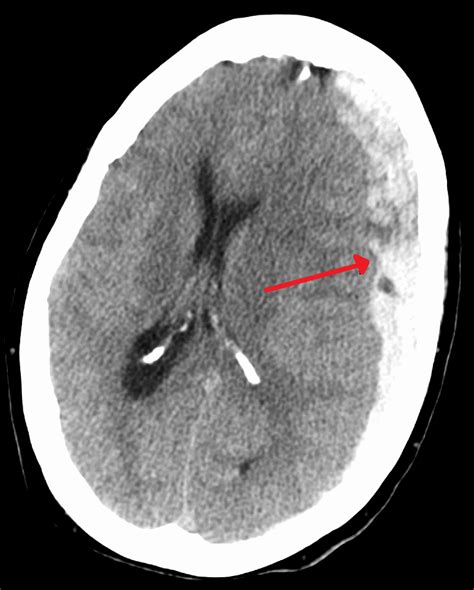 Subdural hematoma - Wikipedia