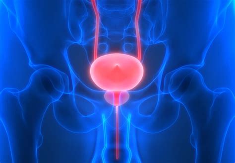 Bladder Neck Contracture (BNC) | Female and Reconstructive Urologist ...