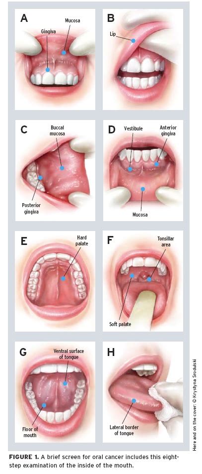 Signs Of Oral Cancer In Cheek - CancerWalls