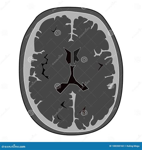 Illustrative Picture of Normal Ct Scan of Head of Human Brain. Stock ...