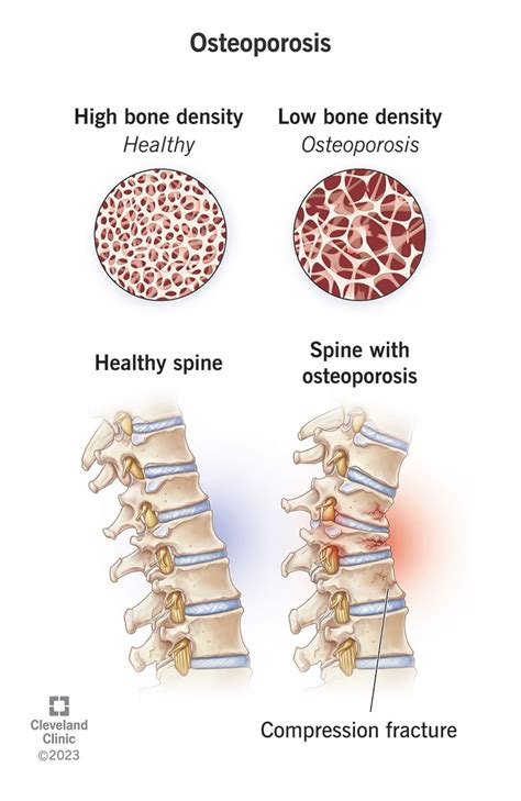 Osteoporosis: Symptoms, Causes And Treatment, 51% OFF