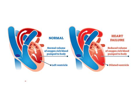 Left Sided Heart Failure, Causes, Symptoms and Treatment | Dr. Raghu