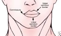 Complex Lip Laceration