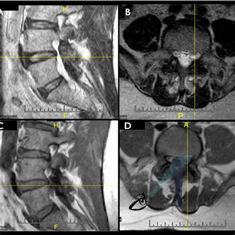 Example of a “ ligamentum flavum cyst ” adjacent to the left L4/L5 ...