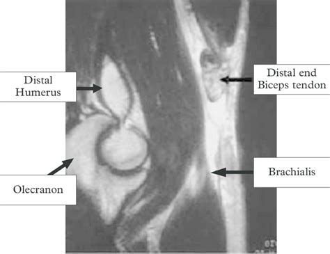 MRI ruptured biceps tendon. | Download Scientific Diagram