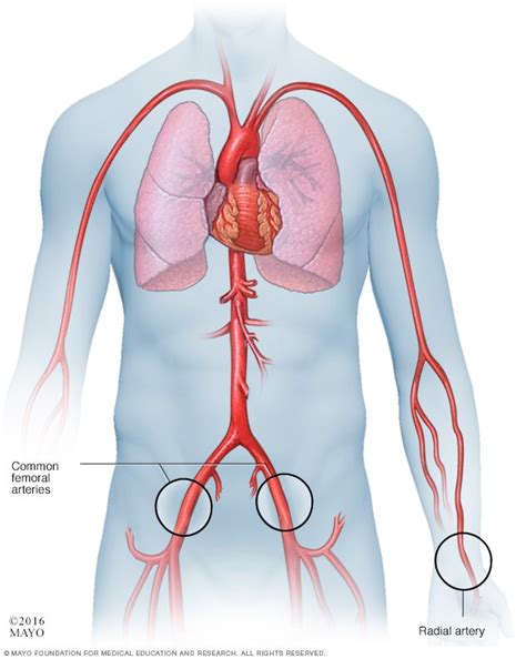 Spontaneous coronary artery dissection (SCAD) - Diagnosis and treatment ...