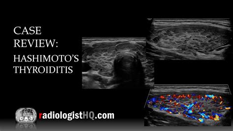 Normal Thyroid Ultrasound