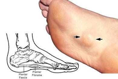 Lump Or Bump On Bottom Of Foot: Causes, Symptoms & Treatment