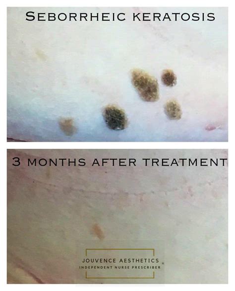 Seborrhoeic keratosis/wart removal at Cheshire Lasers, Middlewich