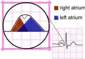 P wave • LITFL • ECG Library Basics