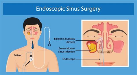 Endoscopic Sinus Surgery Philadelphia | BergerHenry ENT