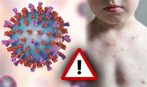 Europe holiday warning: Measles, mumps & rubella fears - Britons urged ...