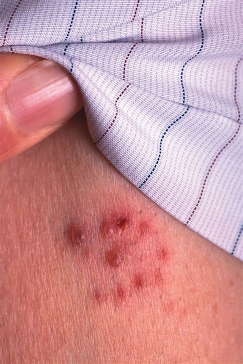 Is that rash shingles? - Harvard Health