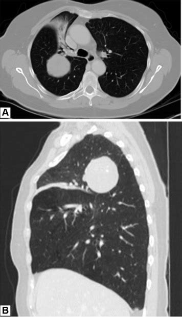 PPSS in a 68-year-old woman. (A) Axial contrast-enhanced CT scan of the ...