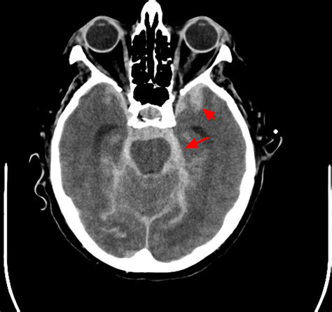 Intracranial Hemorrhage - Cause, Symptoms, Diagnosis, Treatment