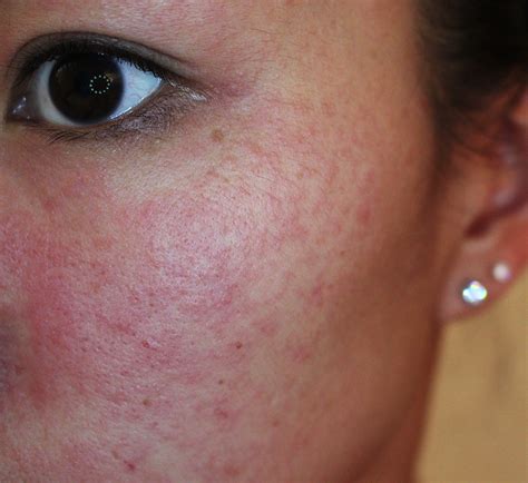 Allergic Reaction To Makeup Rash - Mugeek Vidalondon