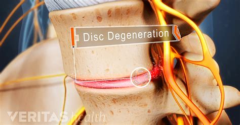 What Is Degenerative Disc Disease?