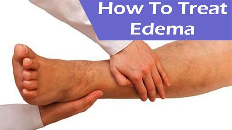 Edema - Causes, Flash Pulmonary, Corneal, Peripheral, Treatment