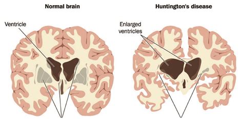 What are the Signs and Symptoms of Huntington’s Disease - Bridge Clinic