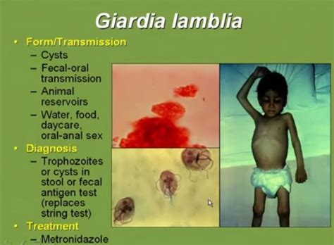 Pin on Giardia lamblia