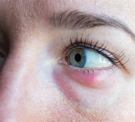 Styes & Chalazion | Symptoms, Causes and Treatment | OcuWellness