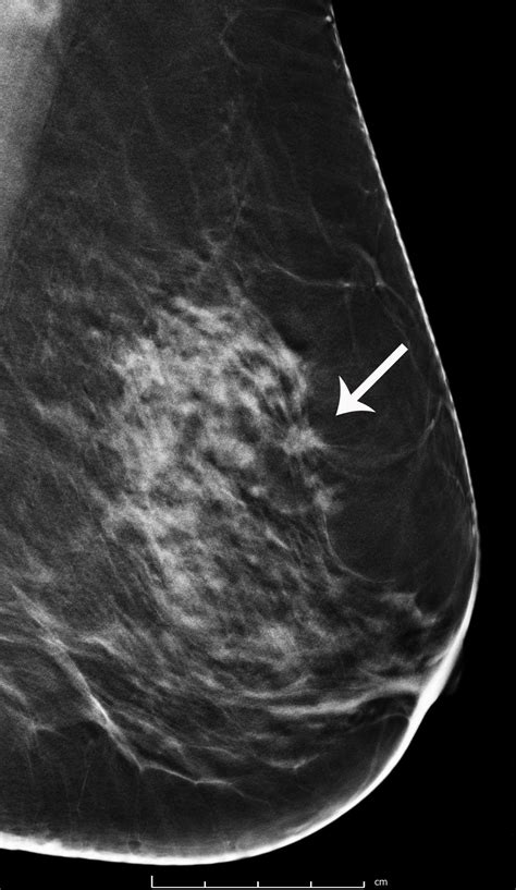 Breast Cancer Screening with 3D Mammography or Tomosynthesis ...