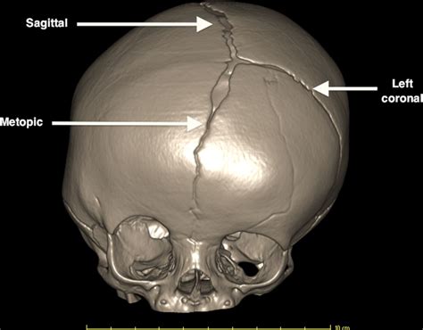 Imaging in craniosynostosis | Archives of Disease in Childhood