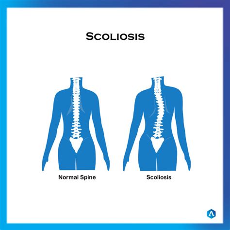 Scoliosis | Dr. Abbie Clinics