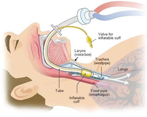 How does ventilation therapy for respiratory problems work?