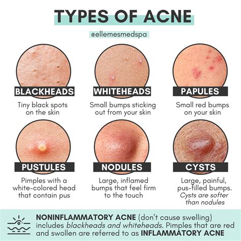 Acne Nodule Vs Cyst